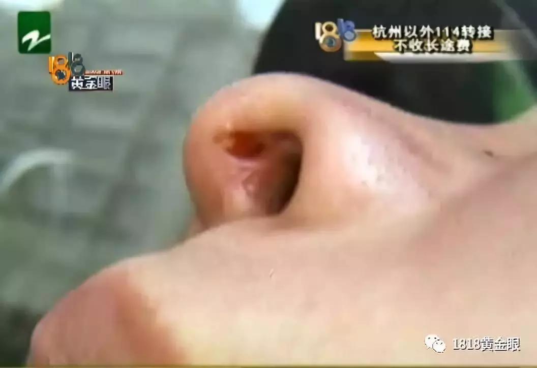 脸上有个小洞一直流脓,脸上有一个毛孔反复化脓结痂