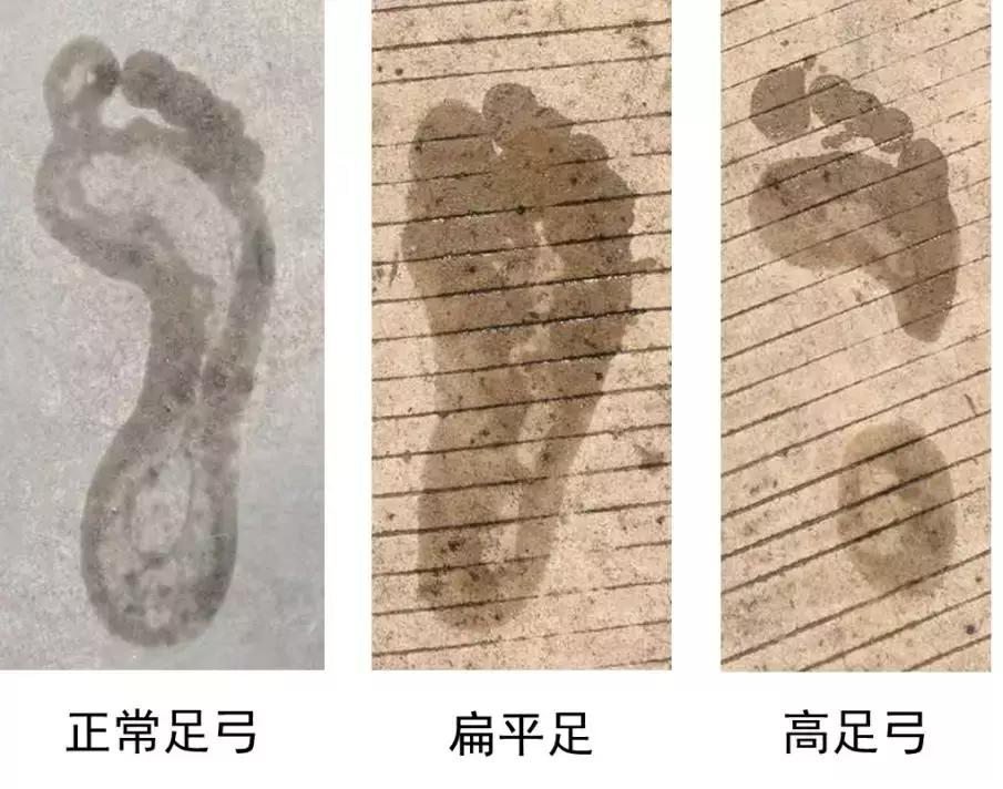 跑者膝盖痛,跑者右侧臀部疼怎么办