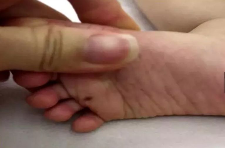 宝宝从小脚上就长黑痣是怎么回事,小孩脚后跟长了颗黑痣越来越大