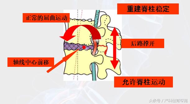 椎间盘突出如何保养防复发,椎间盘突出手术复发后中医治疗