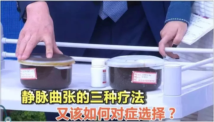 腿部网状静脉曲张的最快消除方法,怎样治静脉曲张和蚯蚓腿