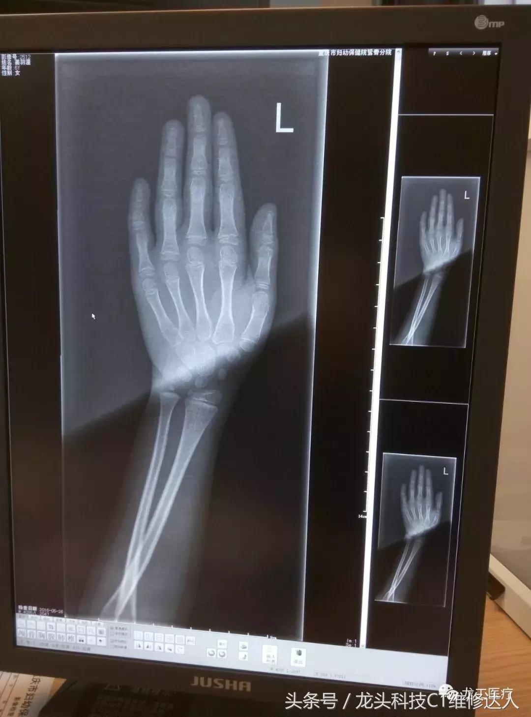 飞利浦pq182修理,飞利浦dsa维修案例