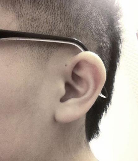 耳朵上方有小洞,耳朵上方有一个小洞代表什么