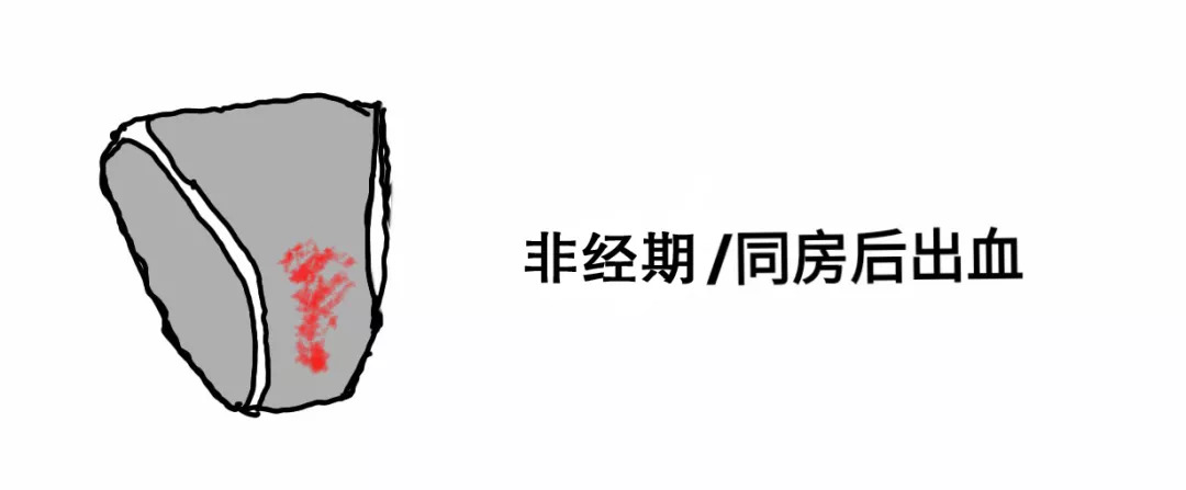 女性宫颈糜烂有什么症状和现象,宫颈糜烂用什么药好得快效果好