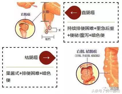 暗红色的便血一定是肠癌吗,大便便血是什么病的预兆