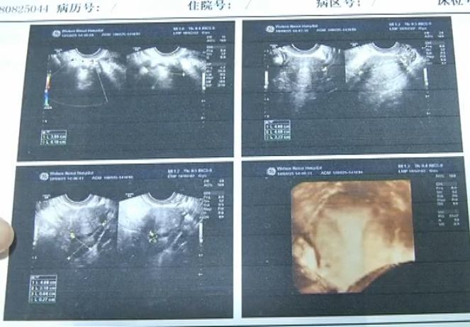 未婚女孩体内发现头发和骨头,22岁未婚女孩月经不正常是咋回事