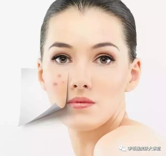 「杏林微资讯」打击痘印，趁早行动！