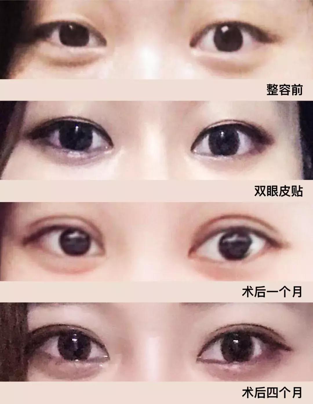 60岁整容亲身经历,整容亲身经历真的好吗