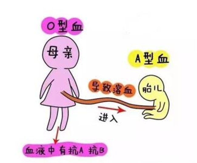 育儿说：父母是什么血型，孩子比较容易发生溶血症？