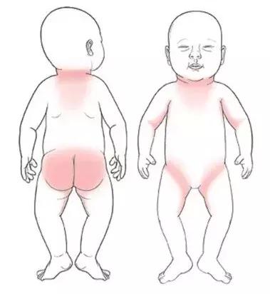 宝宝湿疹康复的全过程,宝宝湿疹不严重也不见好