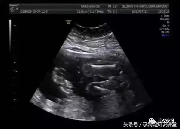 怀了双胞胎,却只生下一个宝宝,医生提醒这是“产科风险之王”