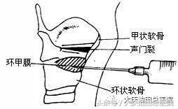 异物呛入气管的急救方法有哪三种,成人大蒜呛到鼻腔小妙招