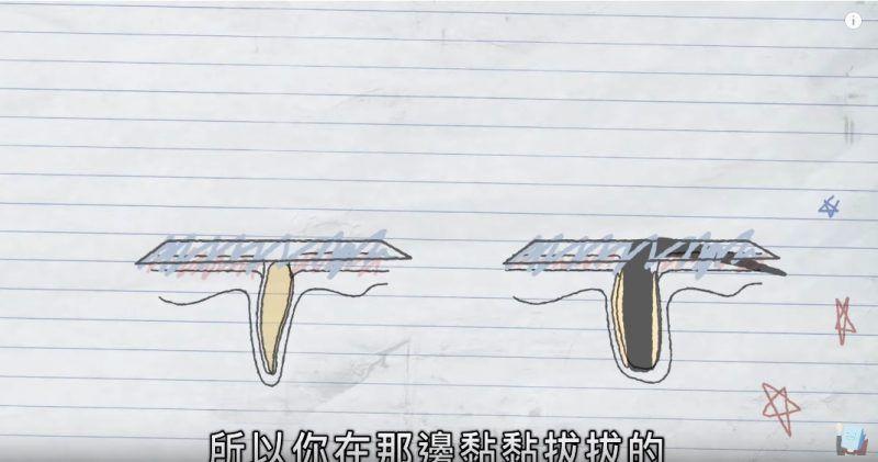 黑头贴吸出来的是粉刺还是黑头,去黑头闭口粉刺用黑头贴可以吗