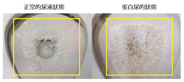 五个多月宝宝尿有点臭是怎么回事,晚上尿味重尿很骚臭是什么疾病