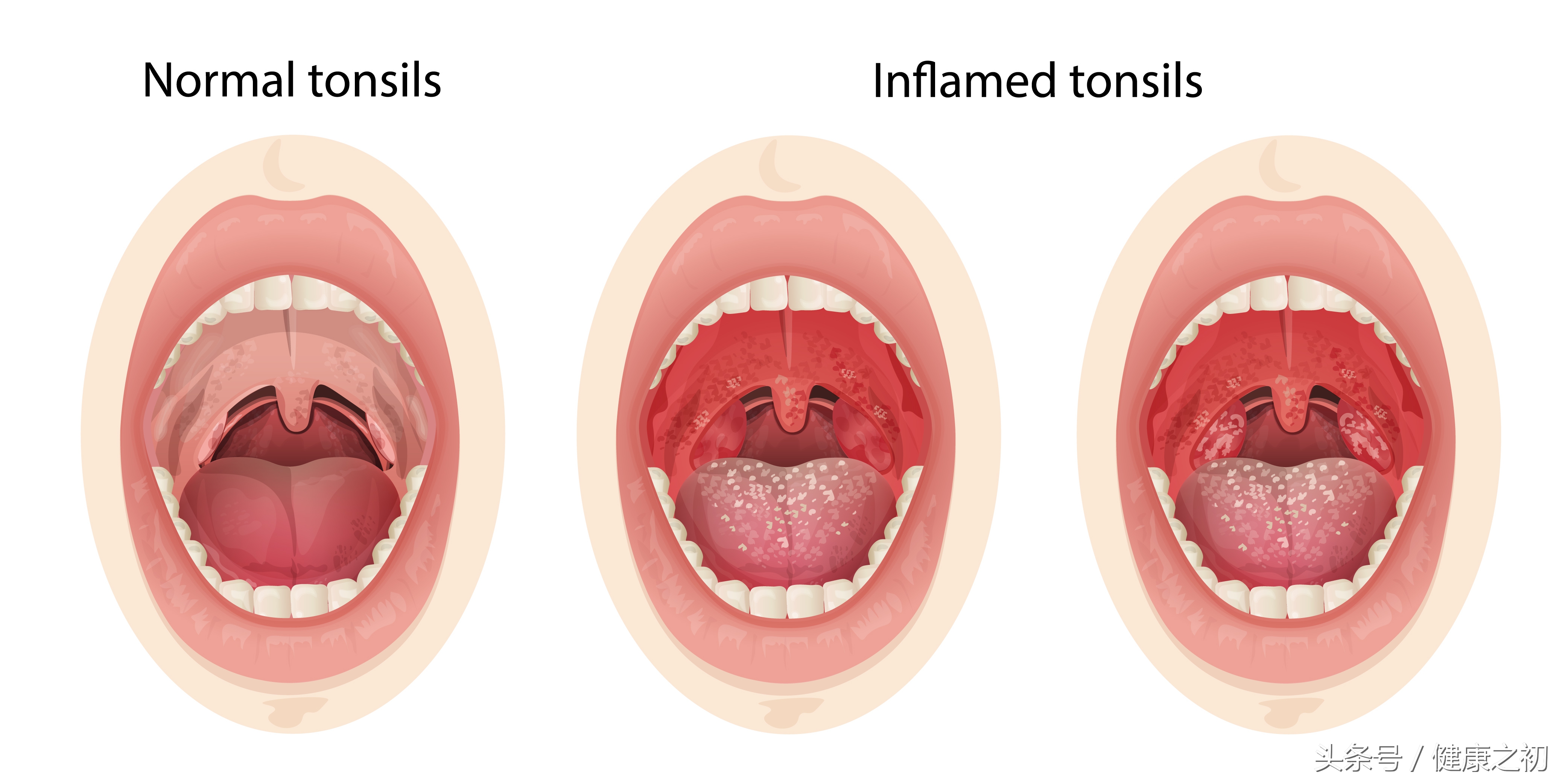 小儿急性扁桃体炎该怎么治疗，什么时候该动手术？