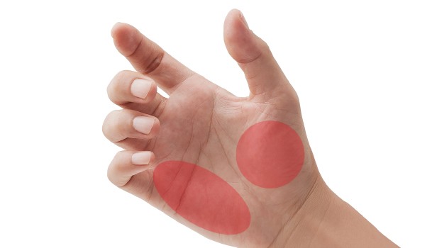 肝硬化的皮肤症状有哪些,肝硬化最怕的四种东西