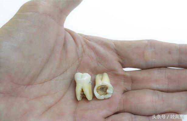 补牙一定要杀死牙神经吗,为什么补牙要杀死牙神经才能补