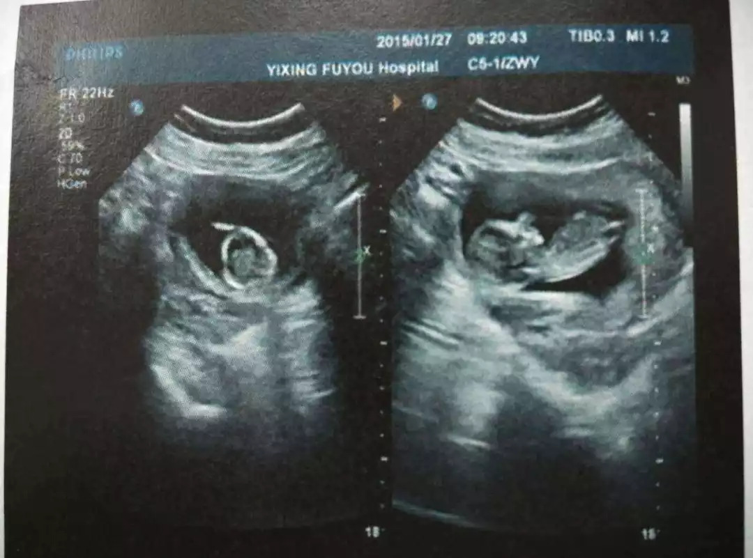 流产之际,28岁广州妈妈用了这一招,住院98天后成功救回宝宝