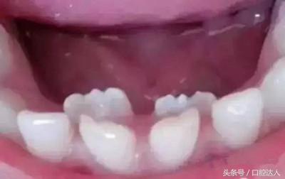 长两排牙的小孩,长了两排牙是怎么回事