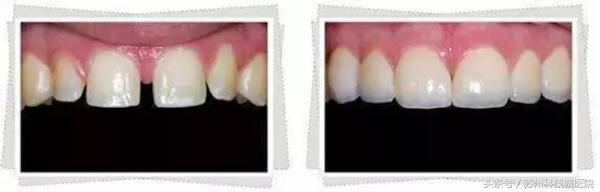 门牙有道缝，美丽关不住