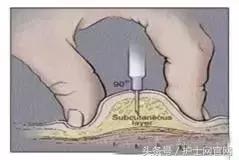 低分子肝素皮下注射后血肿,长期打低分子肝素导致的皮下硬结