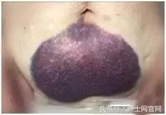 低分子肝素皮下注射后血肿,长期打低分子肝素导致的皮下硬结