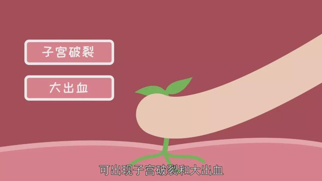 子宫疤痕妊娠会出血吗,子宫疤痕妊娠可以生下来吗