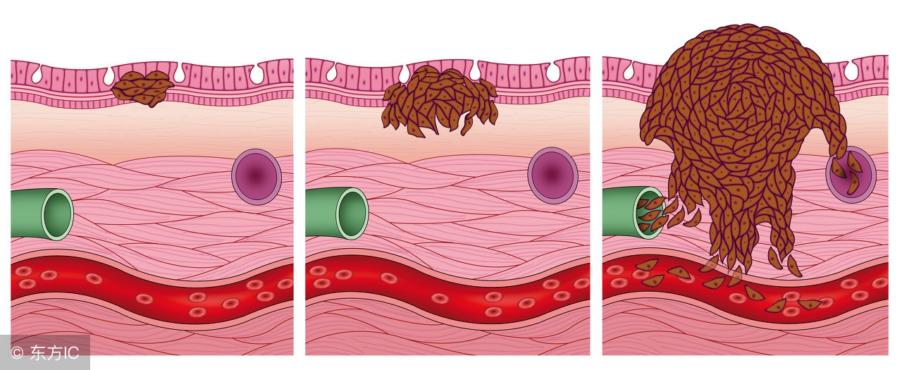 如何尽早发现早期淋巴癌,哪些人容易得淋巴癌