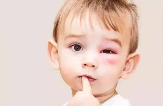 宝宝被蚊子咬了红肿厉害怎么办,蚊子咬了红肿痒擦什么药膏好得快