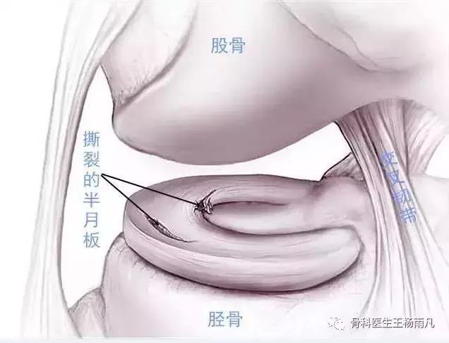 关于半月板的正确说法,半月板前世是什么