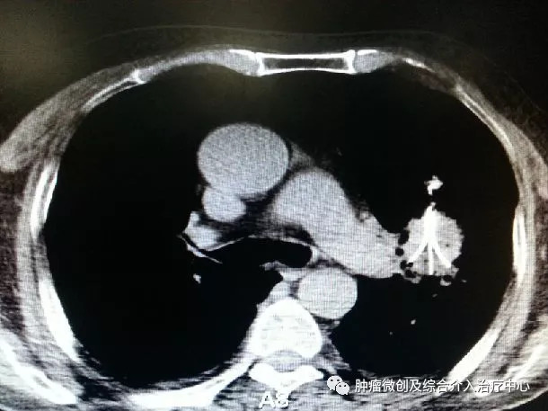 肺癌的诊断+综合介入治疗（穿刺活检+肿瘤血管栓塞+消融+碘125例子植入）—运城市第一医院肿瘤微创及综合介入科