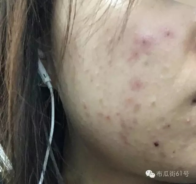 闭口痘痘怎么快速排出来,闭口痘痘身体上长怎么去除