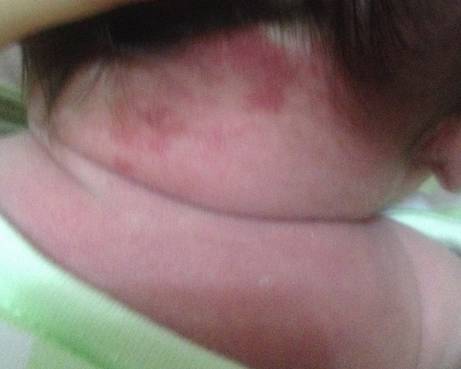 宝宝身上有大面积咖啡色胎记,宝宝胎记黑色斑块图片