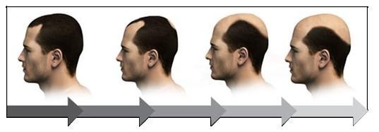 5个原因导致男人脱发,雄激素性脱发能治吗