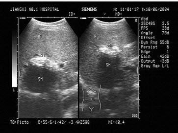 黄疸前期的3个征兆,黄疸的前兆有什么症状和表现