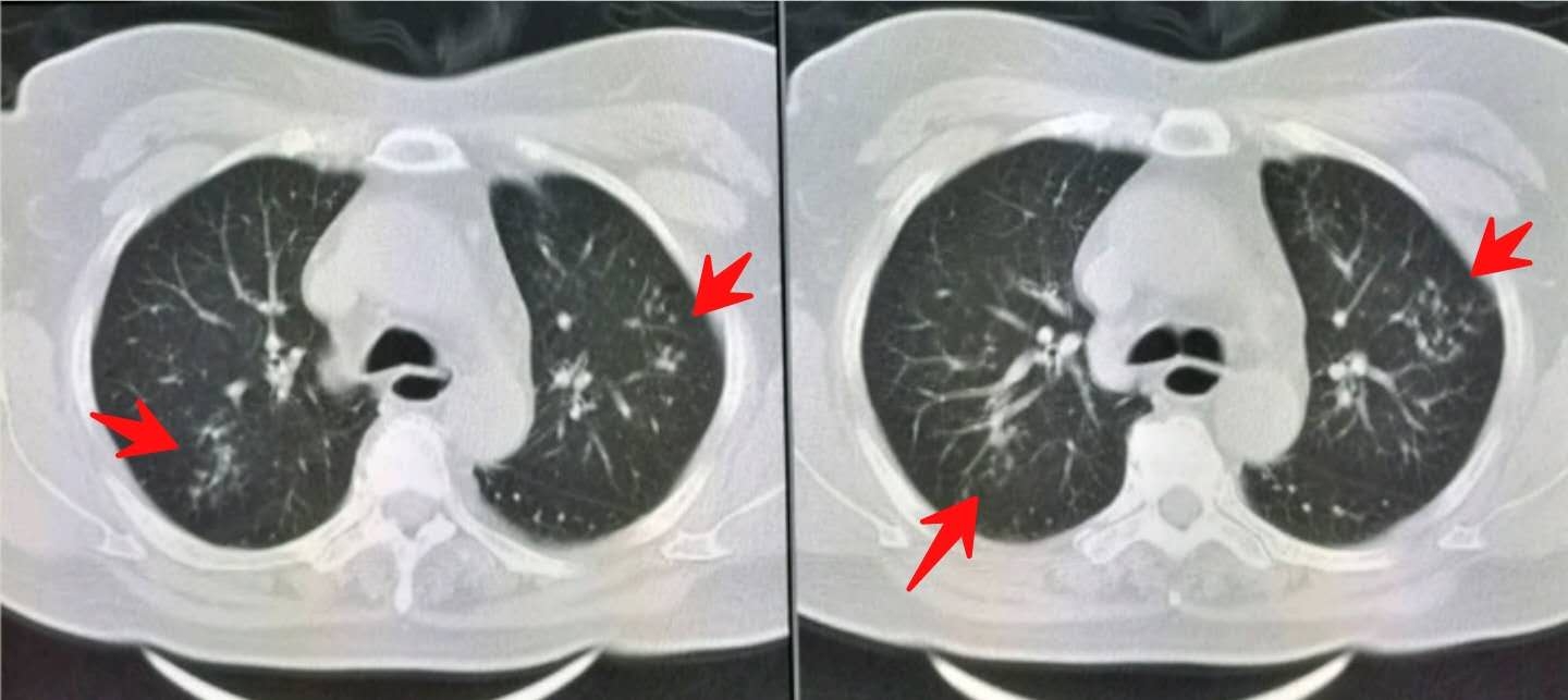 慢性咽炎伴有食道反流该怎么治,慢性咽炎会容易高反吗
