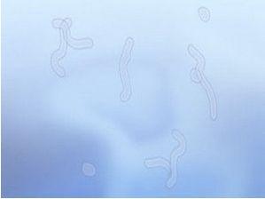 高度近视引起的飞蚊症如何改善,警惕飞蚊症