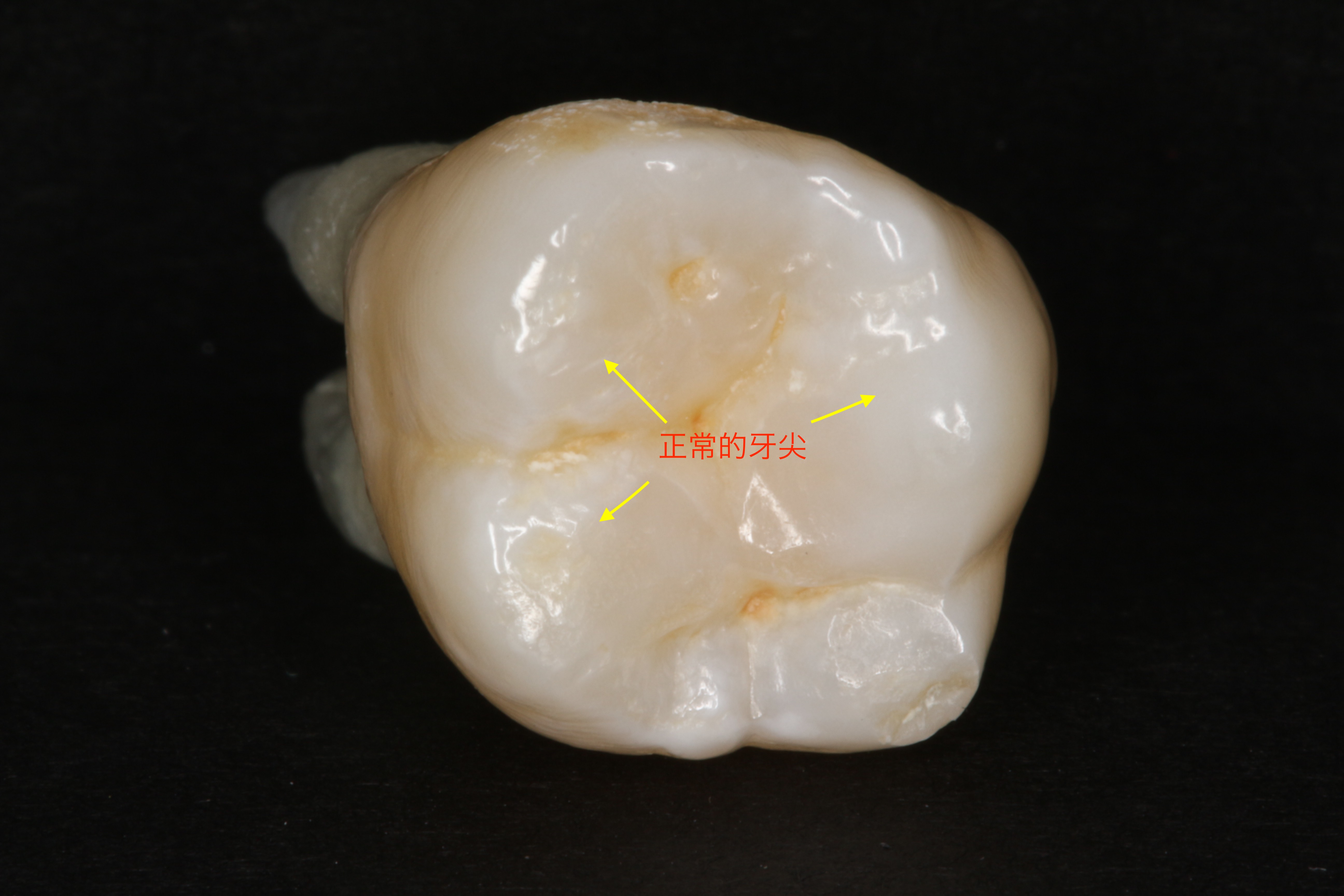 浅隐裂牙怎么处理,隐裂牙有自愈的可能