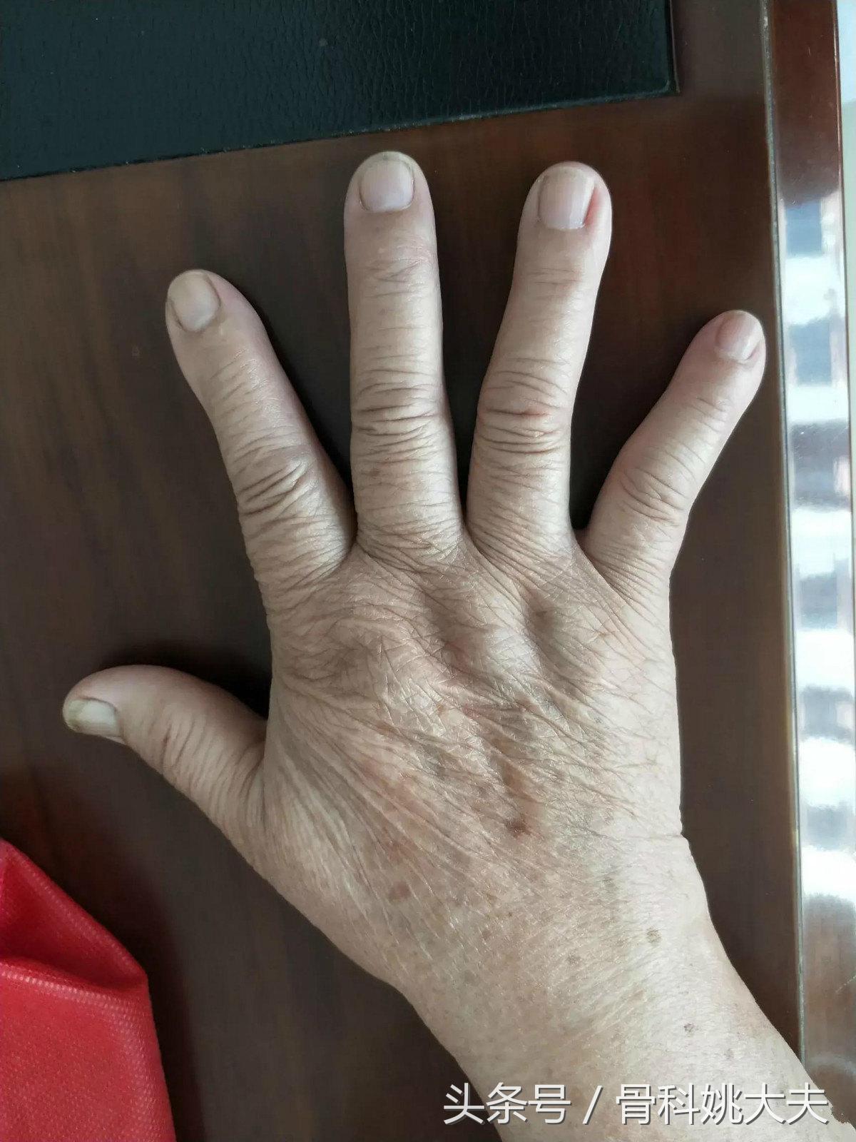 手指关节肥大变形僵硬该吃哪些药,手指第一关节变形凸起是什么病因