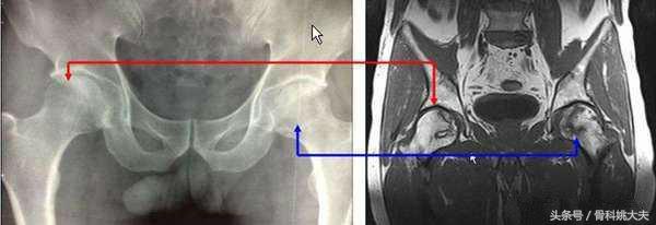 红斑狼疮吃1粒激素严重吗,得了红斑狼疮没有钱治疗怎么办啊