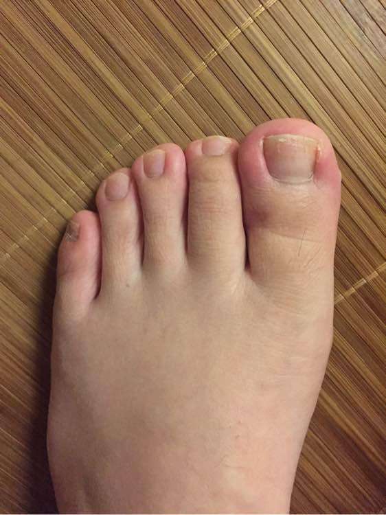 指甲往肉里长太疼了教你简单一招,指甲长在肉里面最好的方法是什么