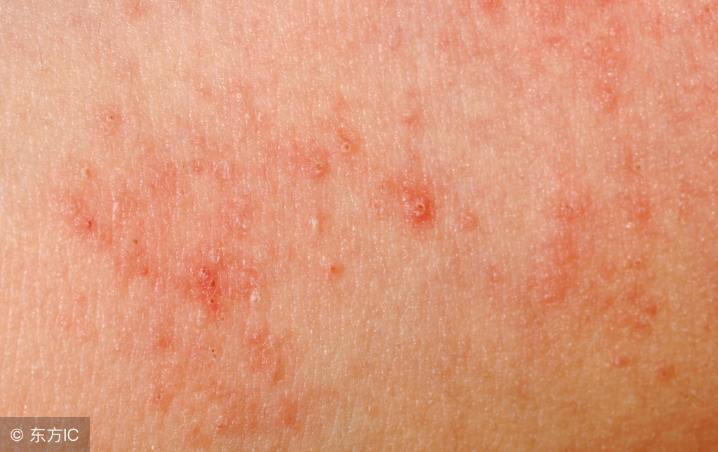 脸上皮炎好了怎么护肤,脸上皮炎怎么治才能除根