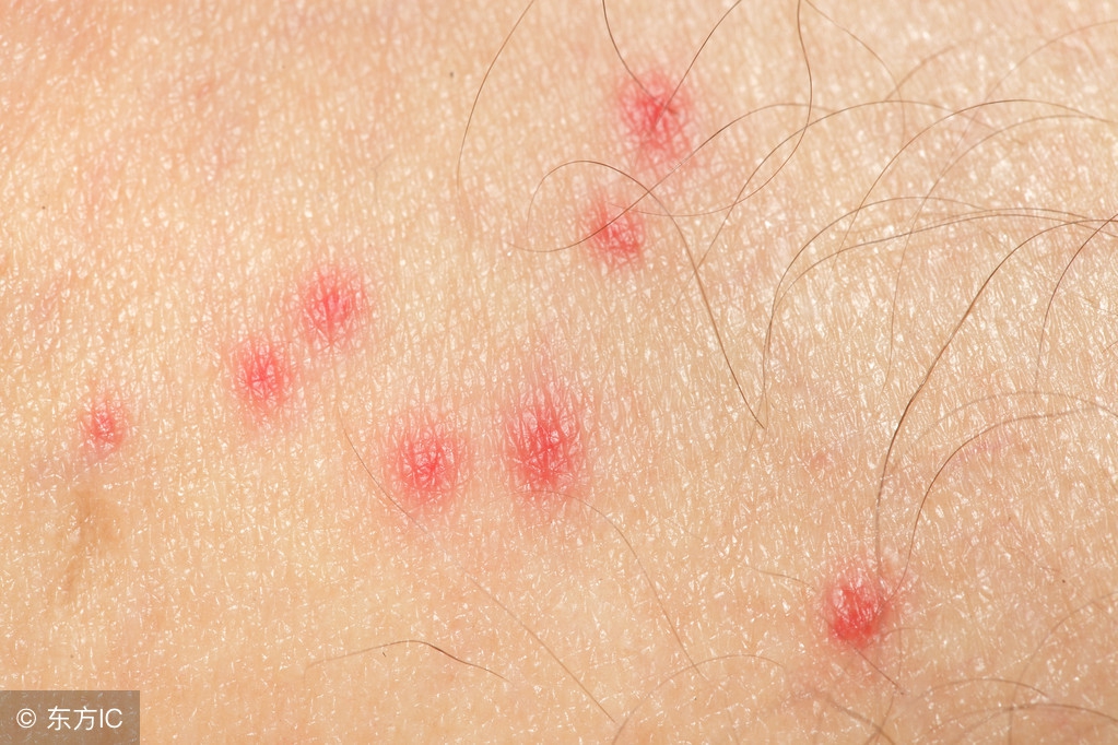 如何解决家里的螨虫,怎样可以解决家里的螨虫