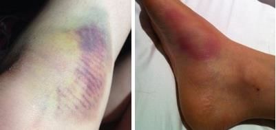 治疗关节炎的日本进口药,告别颈肩腰腿关节疼