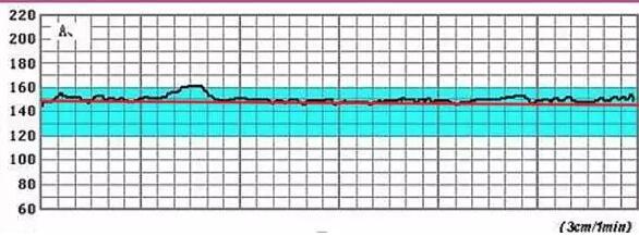 胎心监护有胎心减速是什么原因,胎心监护曲线高低变化大怎么回事