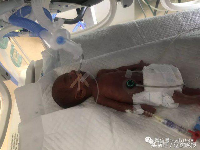 奇迹！出生时仅1.17斤！沈阳这位极早早产宝宝就要出院了！