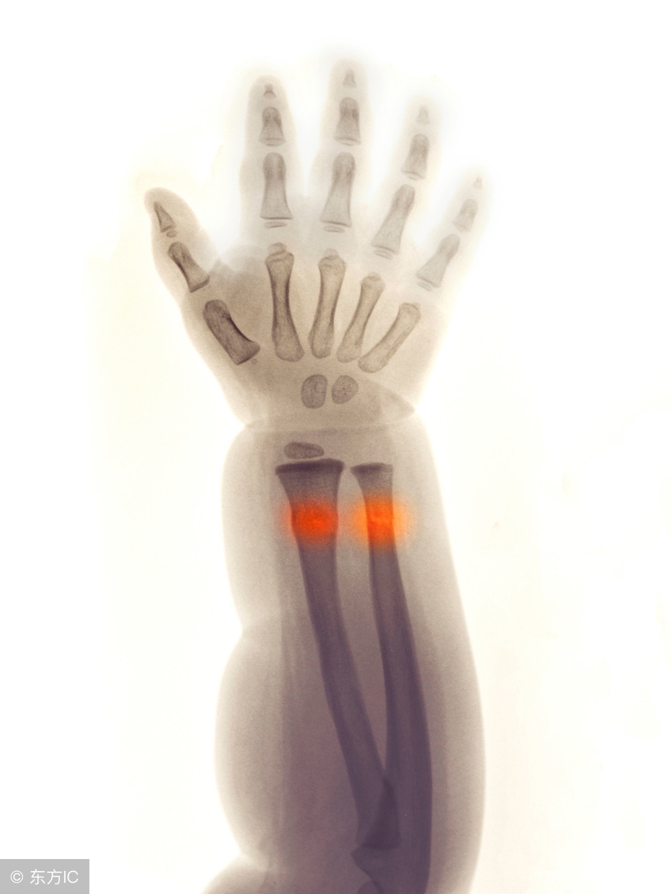 小孩骨折保守治疗不用药水的吗,为什么儿童骨折医生建议保守治疗