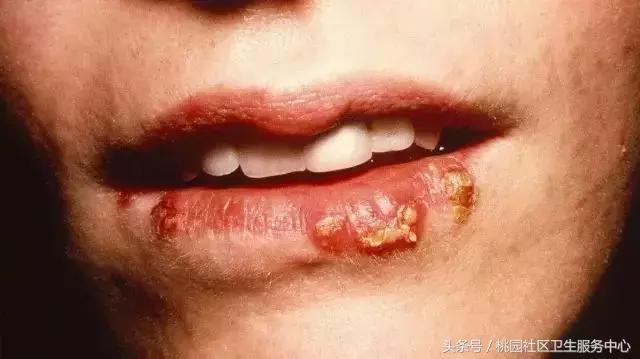 过年嘴巴上火怎么办,嘴巴上火是因为脾气大