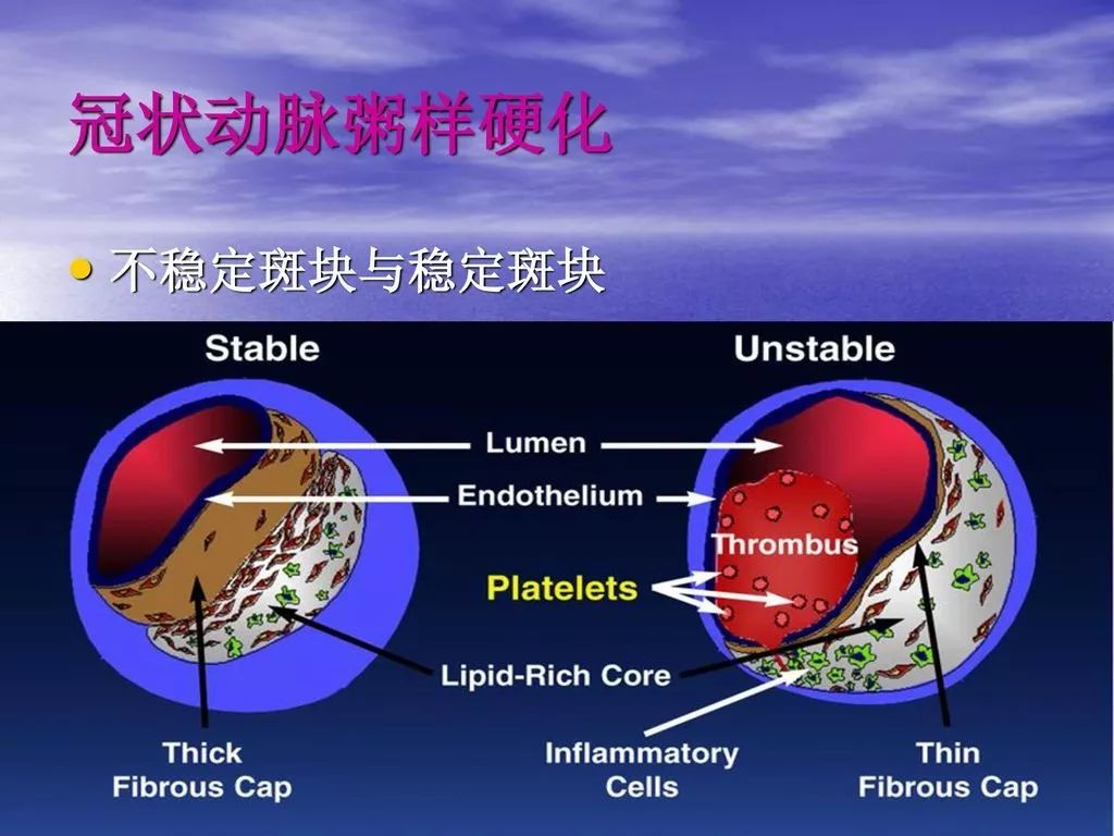冠脉轻度至中度狭窄严重吗,冠脉轻中度狭窄指标正常可停药吗