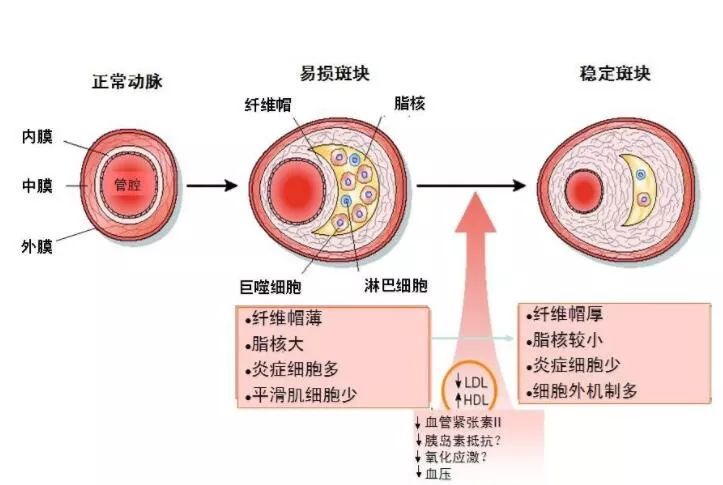 冠脉轻度至中度狭窄严重吗,冠脉轻中度狭窄指标正常可停药吗